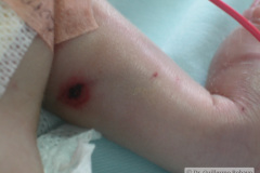 iatrogenia-necrosis-piel-extravasacion-2003-000