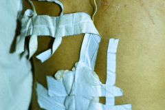 iatrogenia-olvido-retirar-cateter-peridural-001