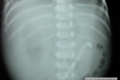 iatrogenia-perforacion-gastrica-sonda-gastrostomia-gastrografia-1985-000