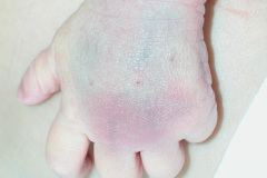 iatrogenia-trauma-hematoma-y-equimosis-mano-por-presion-a-la-venopuncion-2005-000