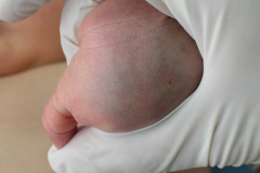 iatrogenia-trauma-hematoma-y-equimosis-mano-por-presion-a-la-venopuncion-2005-002