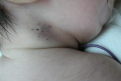 iatrogenia-trauma-puncion-yugular-2002-000
