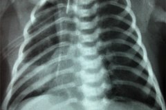 iatrogenia-tubo-torax-mal-insertado-neumotorax-a-tension-recolocacion-1999-000