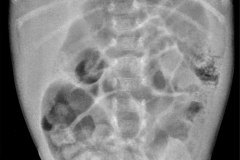 ileon-meconial-impactacion-fecal-2008-001