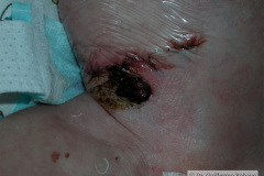 ileostomia-una-boca-000