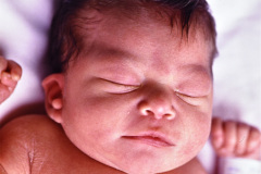 implantacion-baja-pabellon-apendice-preauricular-paresia-facial-der-1992-000