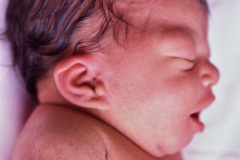 implantacion-baja-pabellon-apendice-preauricular-paresia-facial-der-1992-001