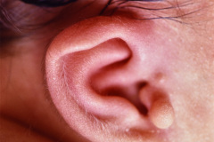 implantacion-baja-pabellon-apendice-preauricular-paresia-facial-der-1992-002