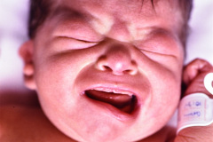 implantacion-baja-pabellon-apendice-preauricular-paresia-facial-der-1992-003