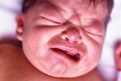 implantacion-baja-pabellon-apendice-preauricular-paresia-facial-der-1992-004