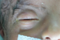 inclinacion-palpebral-antimongoloide-001