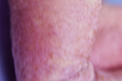 incontinentia-pigmenti-bloch-sulzberger-coloboma-iris-microftalmia-hipertelorismo-epicanto-cuello-corto-vesico-verrugosas-mano-trisomica-1993_03_14-h-rosa-herrera-007