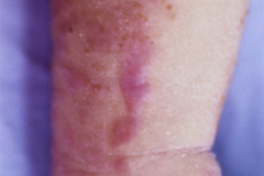 incontinentia-pigmenti-bloch-sulzberger-coloboma-iris-microftalmia-hipertelorismo-epicanto-cuello-corto-vesico-verrugosas-mano-trisomica-1993_03_14-h-rosa-herrera-008