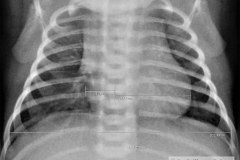 indice-cardiotoracico-ict-0.47-normal-2009-000