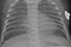 indice-cardiotoracico-ict-0.54-normal-2009-000