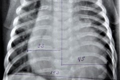 indice-cardiotoracico-ict-0.75-cardiomegalia-1986-001