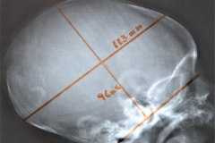 indice-cronqvist-lalan÷dm-x10x100-51-normal-1990-000