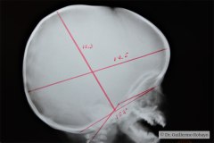 indice-cronqvist-lalan÷dm-x10x100-64-normal-1995-003