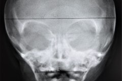 indice-cronqvist-lalan÷dm-x10x100-65-normal-000