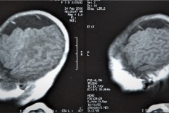 infarto-cerebral-neonatal-masivo-10m-2006-000