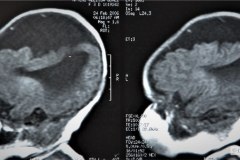 infarto-cerebral-neonatal-masivo-10m-2006-001