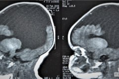 infarto-cerebral-neonatal-masivo-10m-2006-003