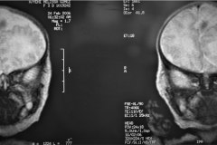 infarto-cerebral-neonatal-masivo-10m-2006-004