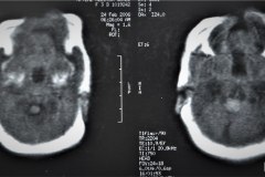 infarto-cerebral-neonatal-masivo-10m-2006-007