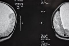 infarto-cerebral-neonatal-masivo-10m-2006-008