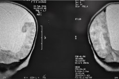 infarto-cerebral-neonatal-masivo-10m-2006-009