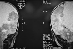 infarto-cerebral-neonatal-masivo-10m-2006-010