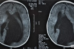 infarto-cerebral-neonatal-masivo-10m-2006-012