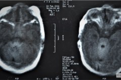 infarto-cerebral-neonatal-masivo-10m-2006-015