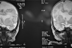 infarto-cerebral-neonatal-masivo-10m-2006-017