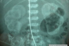 insuficiencia-renal-aguda-medio-contraste-post-urografia-1m-4d-001