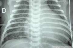 insuficiencia-renal-aguda-por-medio-contraste-urografia-dialisis-enfisema-subcutaneo-2d14d18d27d33d-2003-000