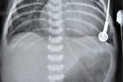 insuficiencia-renal-aguda-por-medio-contraste-urografia-dialisis-enfisema-subcutaneo-2d14d18d27d33d-2003-001