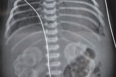 insuficiencia-renal-aguda-por-medio-contraste-urografia-dialisis-enfisema-subcutaneo-2d14d18d27d33d-2003-003