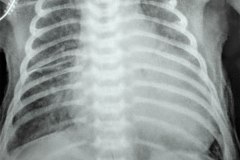 insuficiencia-renal-aguda-por-medio-contraste-urografia-dialisis-enfisema-subcutaneo-2d14d18d27d33d-2003-004