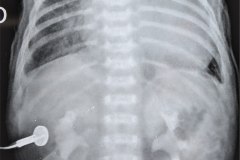 insuficiencia-renal-aguda-por-medio-contraste-urografia-dialisis-enfisema-subcutaneo-2d14d18d27d33d-2003-005