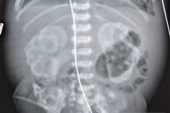 insuficiencia-renal-aguda-por-medio-contraste-urografia-dialisis-enfisema-subcutaneo-2d14d18d27d33d-2003-006