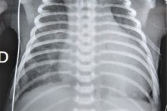insuficiencia-renal-aguda-por-medio-contraste-urografia-dialisis-enfisema-subcutaneo-2d14d18d27d33d-2003-007