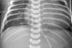 insuficiencia-renal-aguda-por-medio-contraste-urografia-dialisis-enfisema-subcutaneo-2d14d18d27d33d-2003-008
