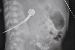 insuficiencia-renal-aguda-por-medio-contraste-urografia-dialisis-enfisema-subcutaneo-2d14d18d27d33d-2003-009