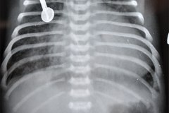 insuficiencia-renal-aguda-por-medio-contraste-urografia-dialisis-enfisema-subcutaneo-2d14d18d27d33d-2003-010