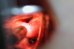 intubacion-nasotraqueal-001