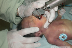intubacion-nasotraqueal-005