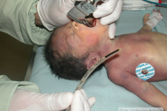intubacion-nasotraqueal-008