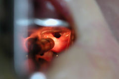 intubacion-nasotraqueal-009
