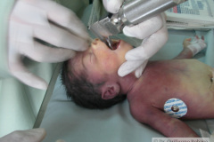 intubacion-nasotraqueal-011